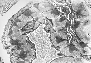 F,74y. | membranous glomerulopathy